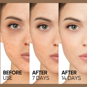 Teashell Niacinamide Brightening Serum | Fade Dark Spots, Acne Marks & Even Skin Tone