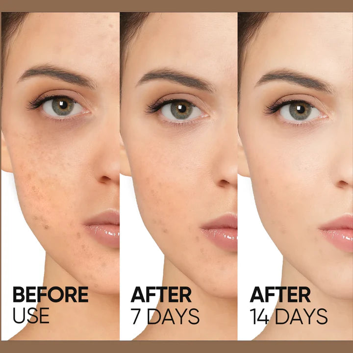 Teashell Niacinamide Brightening Serum | Fade Dark Spots, Acne Marks & Even Skin Tone