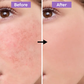 Teashell Niacinamide Brightening Serum | Fade Dark Spots, Acne Marks & Even Skin Tone