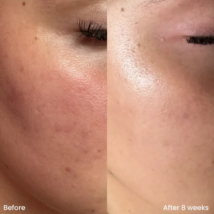 Teashell Niacinamide Brightening Serum | Fade Dark Spots, Acne Marks & Even Skin Tone