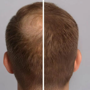 Bare Anatomy Advanced Hair Growth Roll-On Serum | 3% Redensyl + 4% Anagain + 2% Baicapil + 5% Rosemary | Direct Scalp Application for Thicker, Stronger Hair