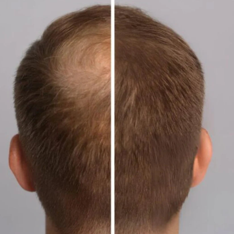 Bare Anatomy Advanced Hair Growth Roll-On Serum | 3% Redensyl + 4% Anagain + 2% Baicapil + 5% Rosemary | Direct Scalp Application for Thicker, Stronger Hair