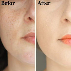 Teashell Niacinamide Brightening Serum | Fade Dark Spots, Acne Marks & Even Skin Tone