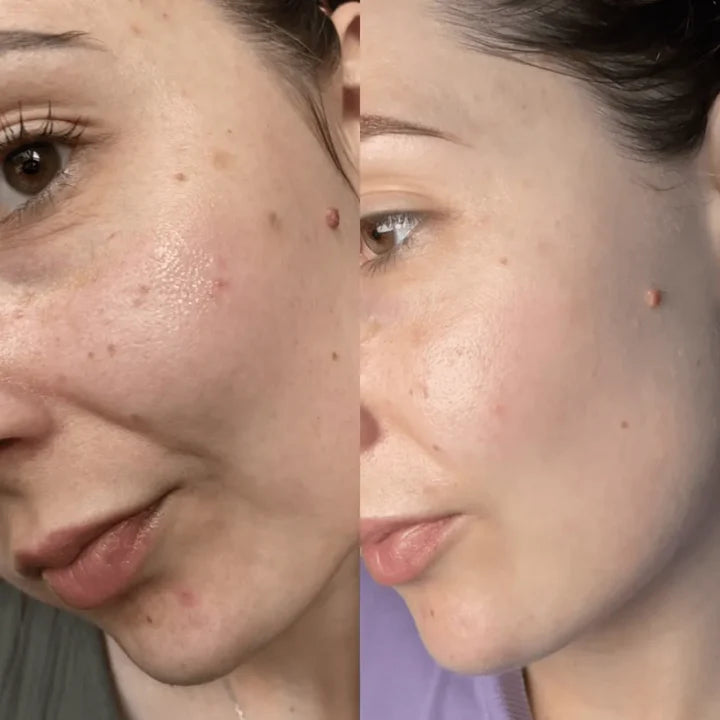 Teashell Niacinamide Brightening Serum | Fade Dark Spots, Acne Marks & Even Skin Tone