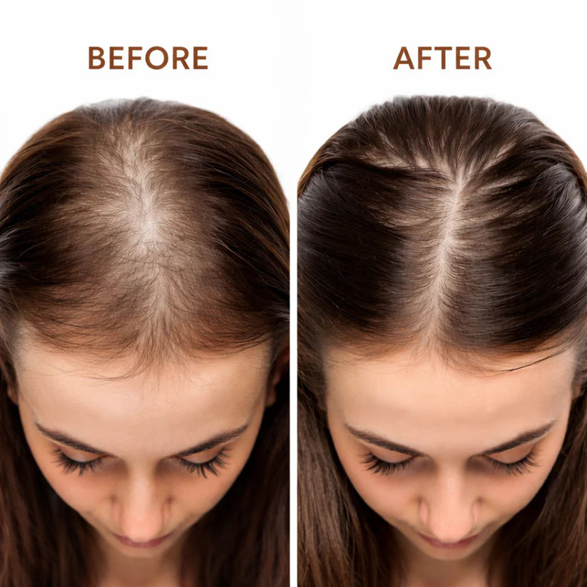 Bare Anatomy Advanced Hair Growth Roll-On Serum | 3% Redensyl + 4% Anagain + 2% Baicapil + 5% Rosemary | Direct Scalp Application for Thicker, Stronger Hair