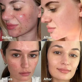 Teashell Niacinamide Brightening Serum | Fade Dark Spots, Acne Marks & Even Skin Tone