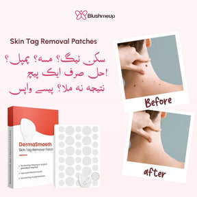 DermaSmooth Skin Tag Remover Patch